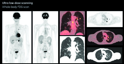 Ultra low-dose scanning Whole-body FDG scan